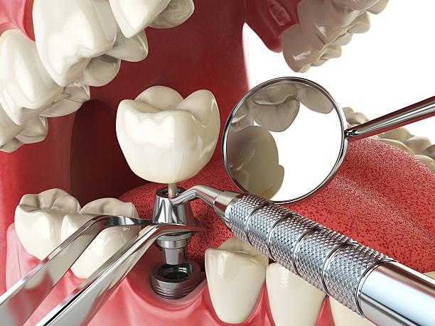 Best Emergency Dentist for Lost Fillings or Crowns in Flower Hill, MD